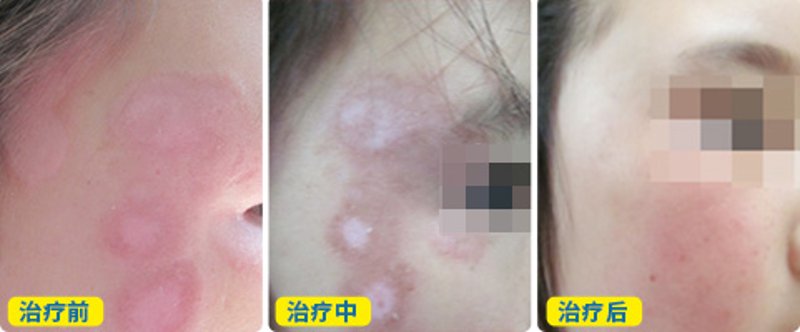 白癜风治疗费用
