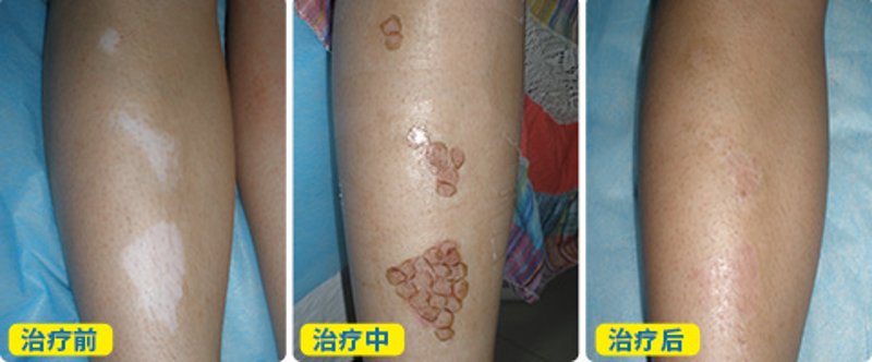 长沙看白癜风哪家好