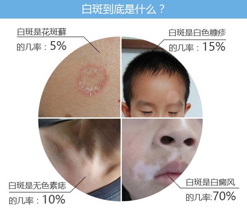 揭秘白癜风治疗费用背后的门道